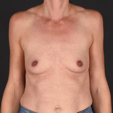 Before image 1 Case #133681 - Breast Augmentation
