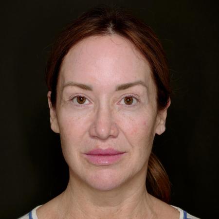 Before image 1 Case #133616 - Deep Plane Face Lift