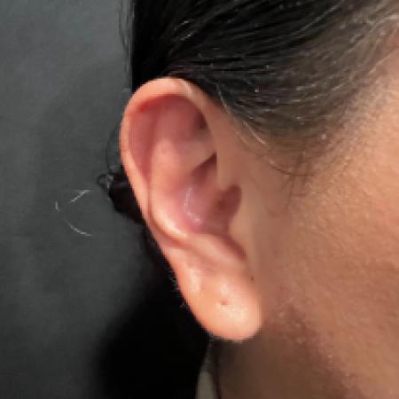 Before image 1 Case #133661 - Bilateral Otoplasty