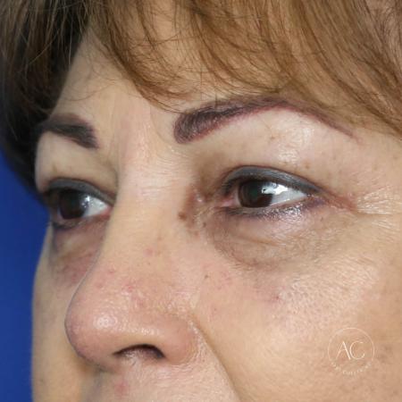 After image 2 Case #134661 - Upper blepharoplasty