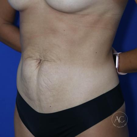Before image 2 Case #134656 - Abdominoplasty with liposuction