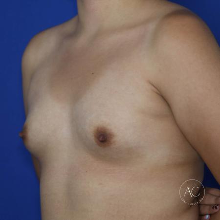 Before image 2 Case #134621 - Breast augmentation