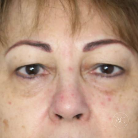 Before image 1 Case #134661 - Upper blepharoplasty