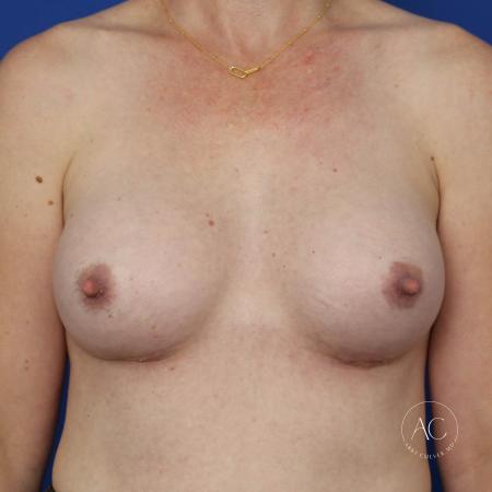 After image 1 Case #134651 - Breast augmentation