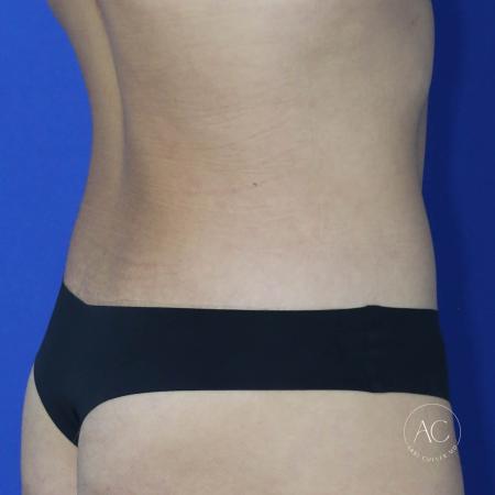 After image 4 Case #134666 - Extended abdominoplasty with liposuction