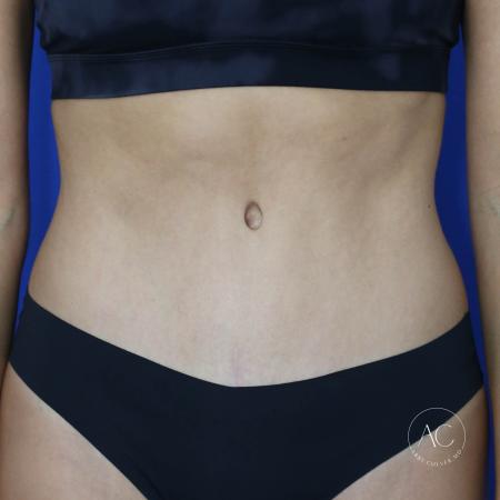 After image 1 Case #134656 - Abdominoplasty with liposuction