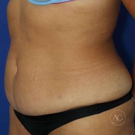 Before image 2 Case #134666 - Extended abdominoplasty with liposuction