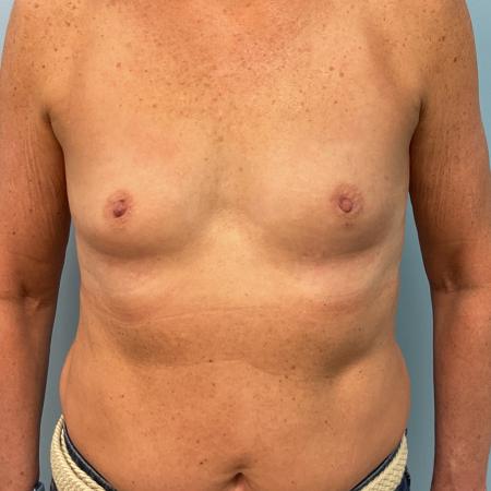 Before image 1 Case #134821 - 72 y.o. female with breast augmentation 