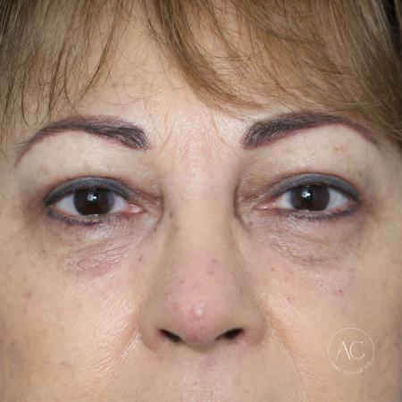 After image 1 Case #134661 - Upper blepharoplasty
