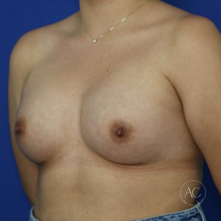 After image 2 Case #134621 - Breast augmentation