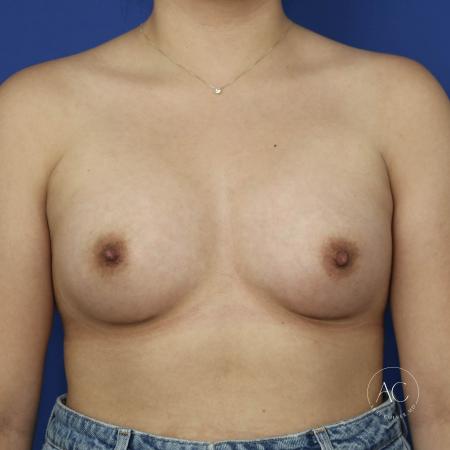 After image 1 Case #134621 - Breast augmentation