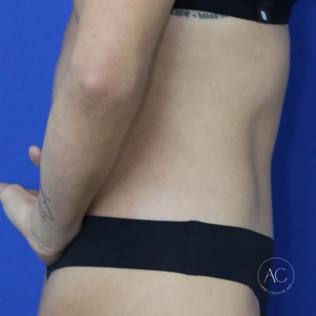 After image 3 Case #134666 - Extended abdominoplasty with liposuction