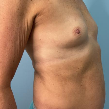 Before image 2 Case #134821 - 72 y.o. female with breast augmentation 