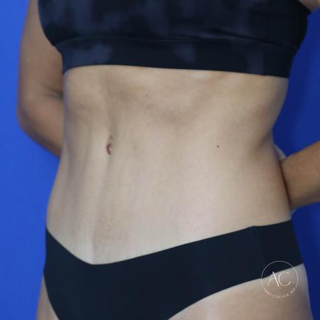 After image 2 Case #134656 - Abdominoplasty with liposuction