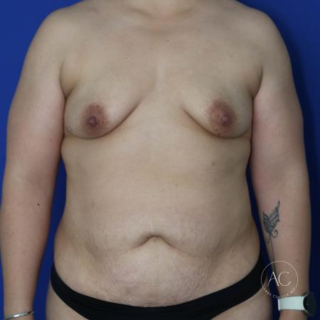 Before image 1 Case #134636 - Breast augmentation with lipoabdominoplasty