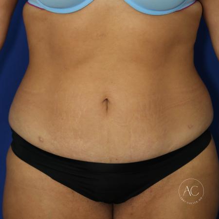 Before image 1 Case #134666 - Extended abdominoplasty with liposuction