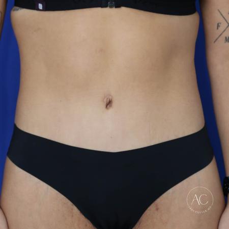 After image 1 Case #134666 - Extended abdominoplasty with liposuction