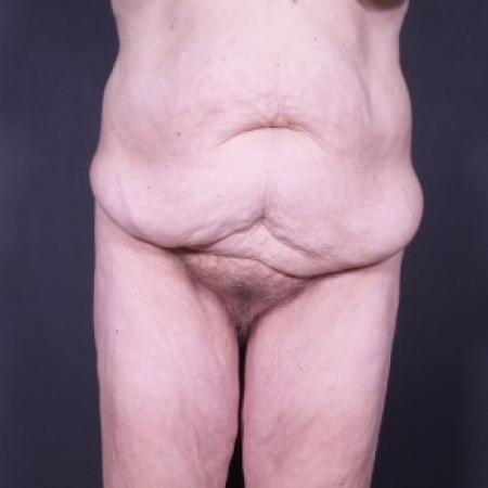Before image 1 Case #85281 - Fleur De Lis Abdominoplasty after Weight Loss