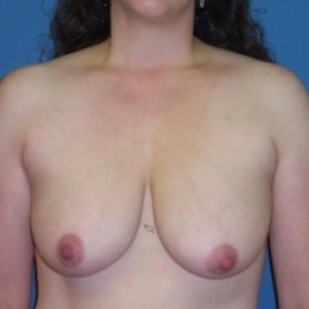 Before image 1 Case #80716 - Breast Lift with Augmentation