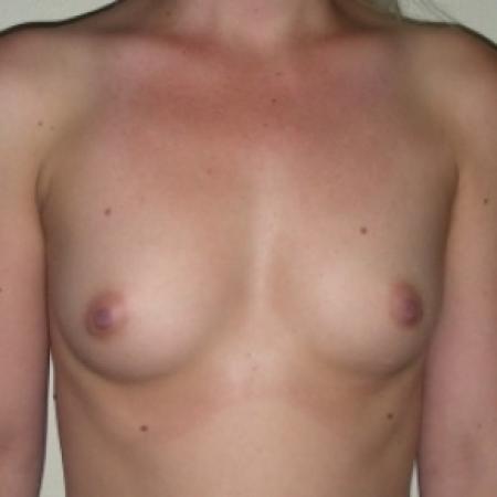 Before image 1 Case #79761 - Breast Augmentation with Silicone Implants for Hypomastia