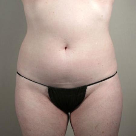 Before image 3 Case #103201 - Mommy Makeover Patient 29
