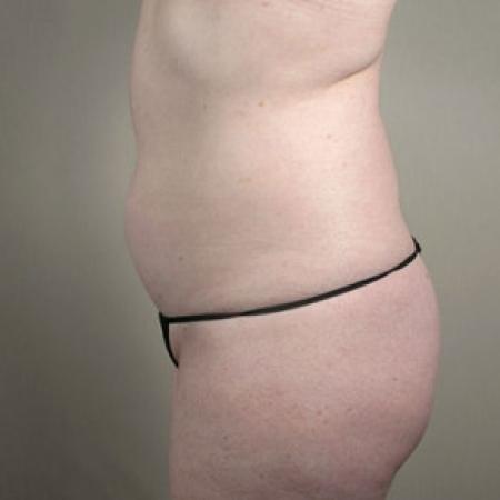 Before image 4 Case #103201 - Mommy Makeover Patient 29