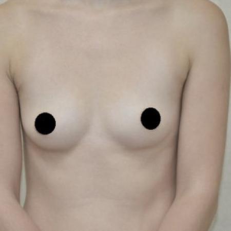 Before image 1 Case #103121 - Breast Augmentation 