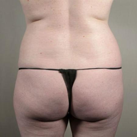 Before image 5 Case #103201 - Mommy Makeover Patient 29