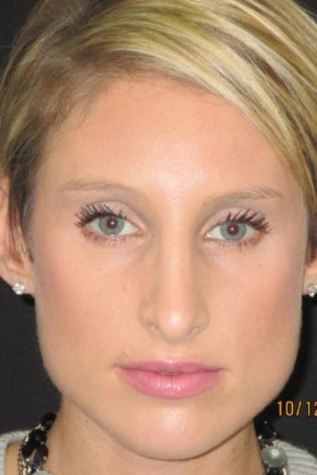 After image 1 Case #82791 - Septorhinoplasty