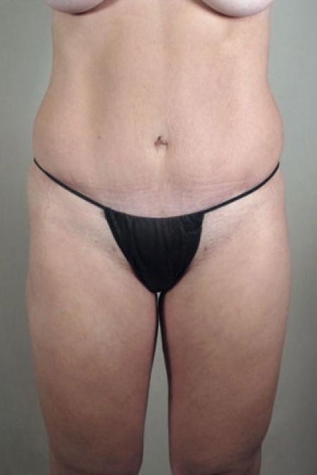 After image 3 Case #103196 - Mommy Makeover Patient 58