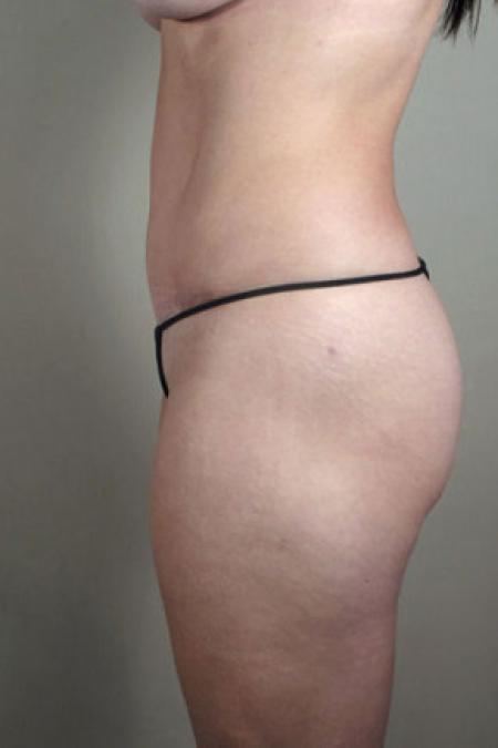 After image 5 Case #103196 - Mommy Makeover Patient 58