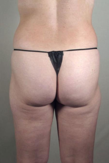 After image 4 Case #103196 - Mommy Makeover Patient 58