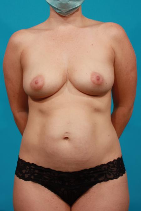 Before image 1 Case #104316 - Mommy Makeover: TT / BA / SAL