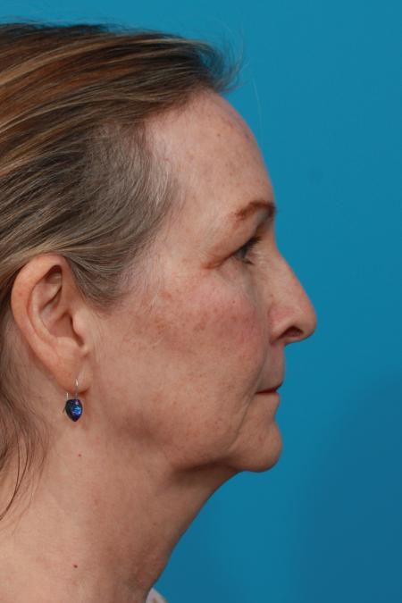 Before image 3 Case #104176 - Face Lift