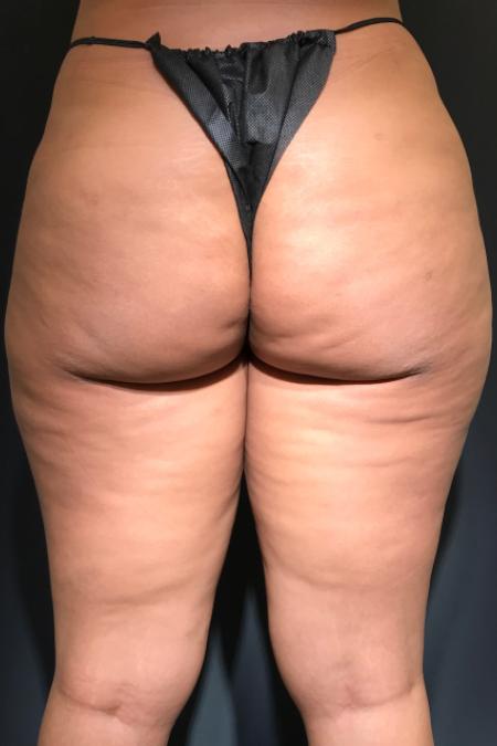 After Case #107906 - Avéli™ (Minimally Invasive Cellulite Reduction)