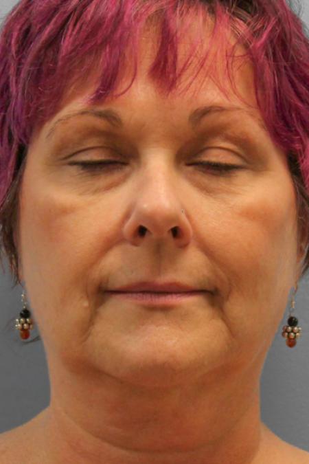 Before image 1 Case #109191 - Facelift & Upper Bleph