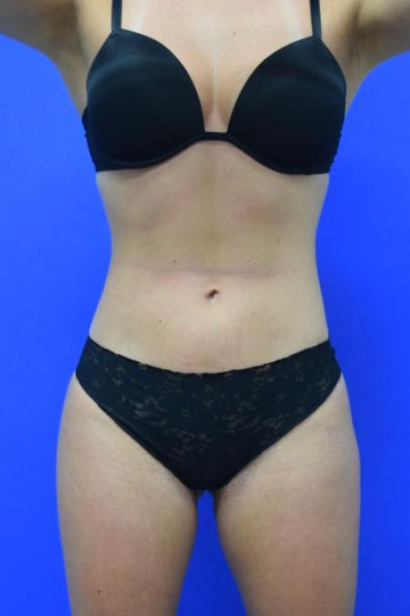 After image 1 Case #110116 - Skinny BBL
