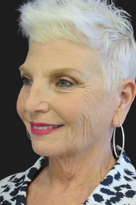 Before image 5 Case #111871 - 59 Year-Old Bride | Facial Rejuvenation