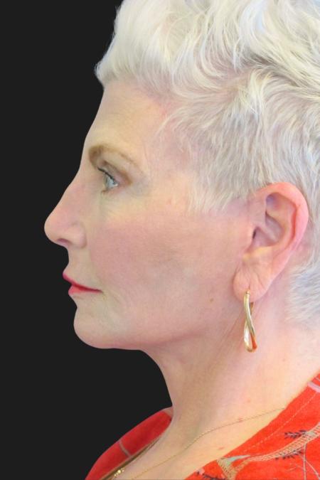 After image 3 Case #111871 - 59 Year-Old Bride | Facial Rejuvenation