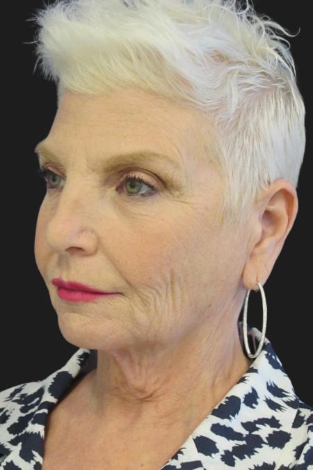 Before image 4 Case #111871 - 59 Year-Old Bride | Facial Rejuvenation