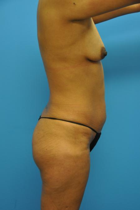 Before image 3 Case #112616 - Mommy Makeover transformation