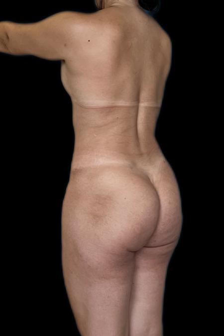 After image 4 Case #117991 - Mommy MakeOver 