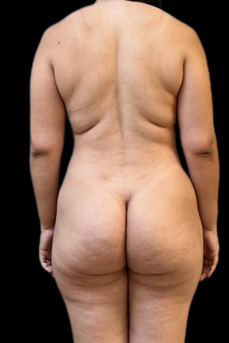 Before image 5 Case #117991 - Mommy MakeOver 