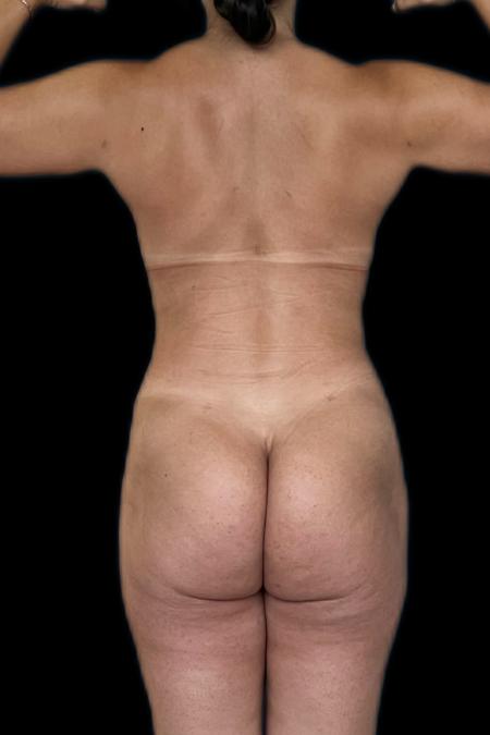 After image 5 Case #117991 - Mommy MakeOver 
