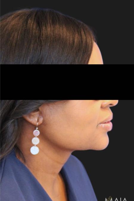 After image 3 Case #119176 - 50 year-old Patient | Neck Lift