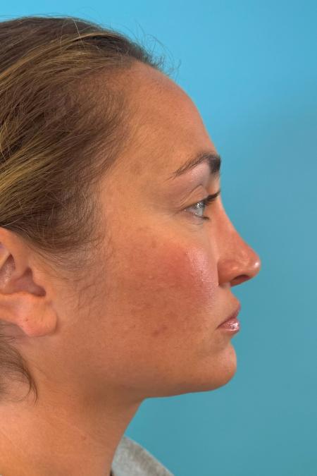 After image 5 Case #119166 - Dream nose!