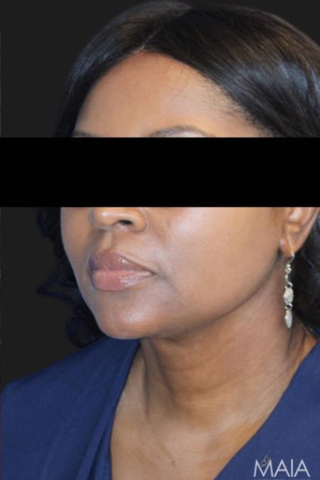After image 2 Case #119176 - 50 year-old Patient | Neck Lift