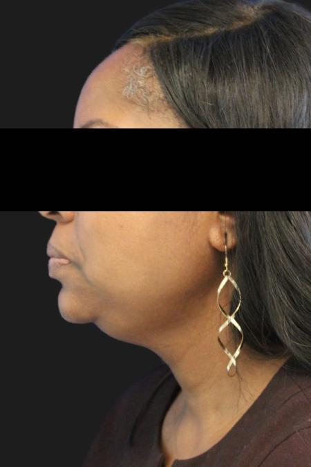 Before image 4 Case #119176 - 50 year-old Patient | Neck Lift