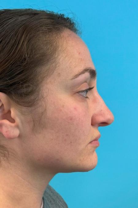 Before image 5 Case #119166 - Dream nose!