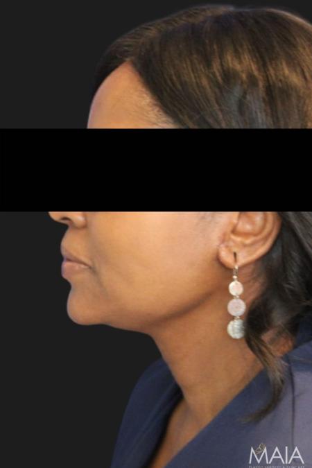 After image 4 Case #119176 - 50 year-old Patient | Neck Lift